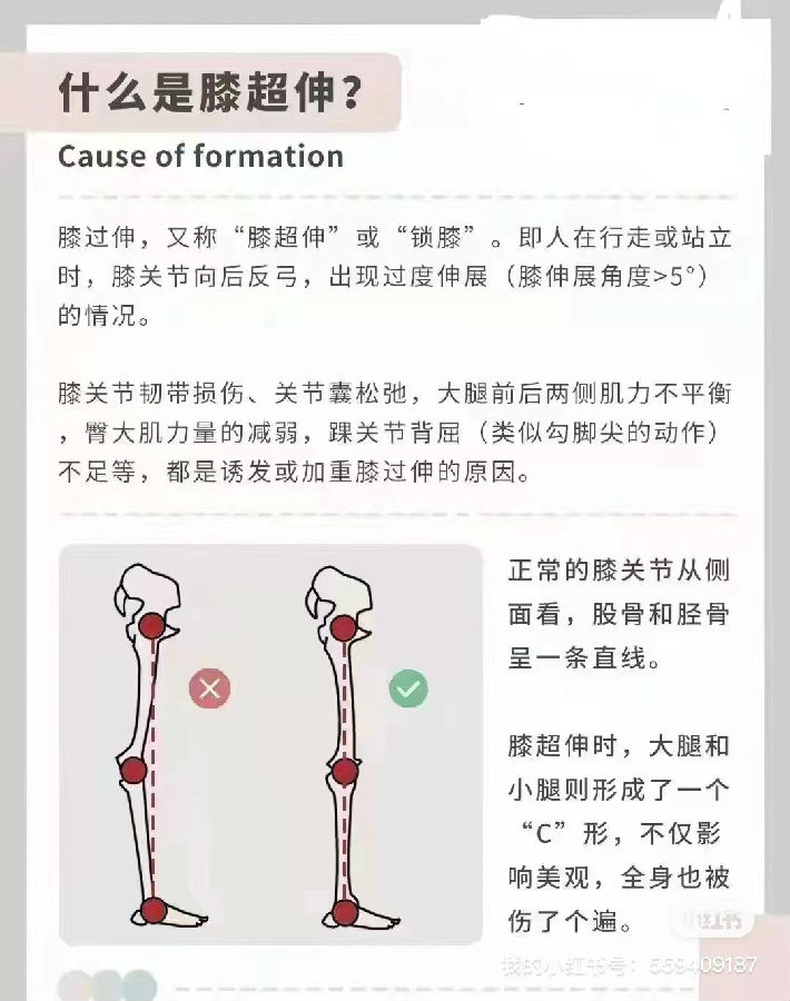 少兒形體問題—膝超伸的危害